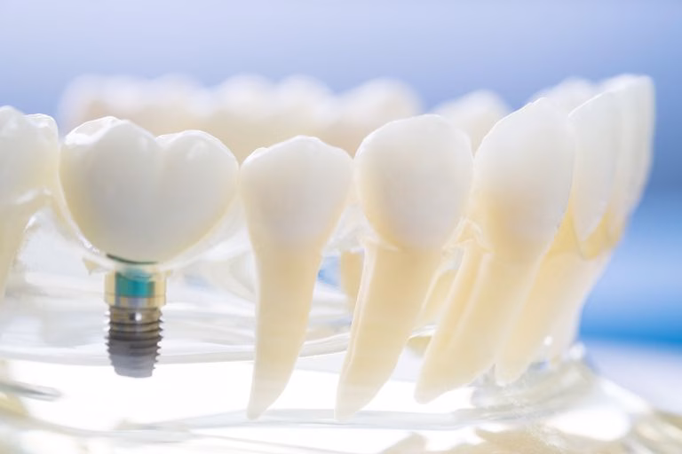 Dental Implant Procedure – Guide And What To Expect