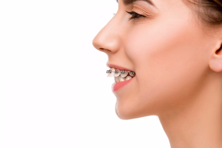 What Is an Overjet in Teeth? 7 Ways You Can Fix It
