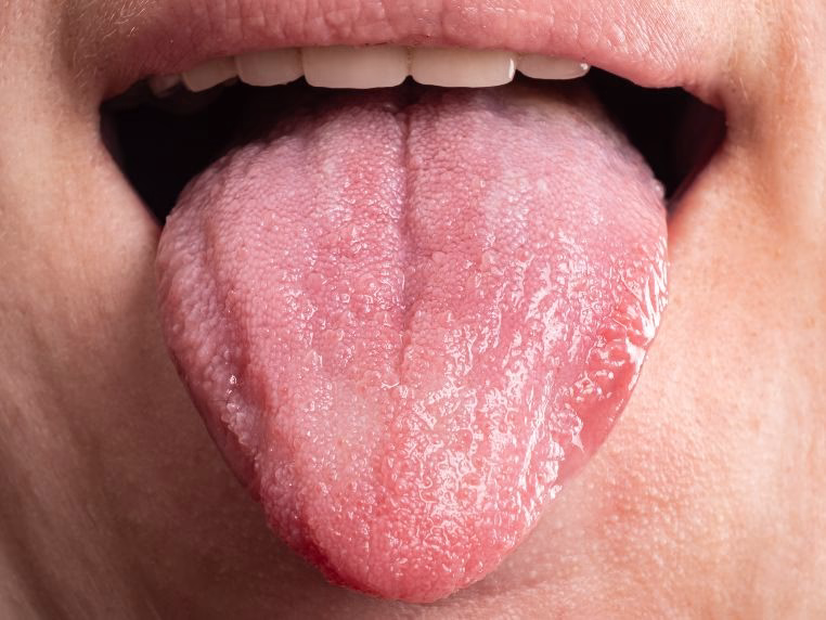 What causes a brown tongue