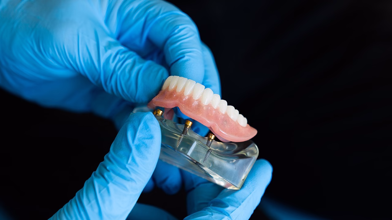 Partial Dentures: Different Types and Possible Alternatives