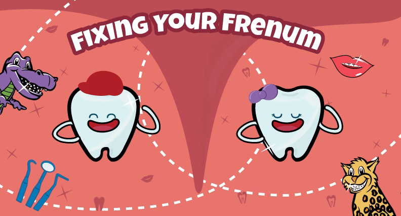 Frenulum in the mouth – possible problems, treatments, and frenectomy