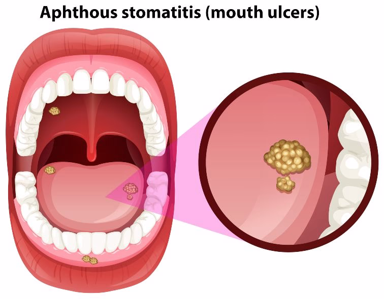 Mouth Ulcers – What Are the Causes and How to Treat It